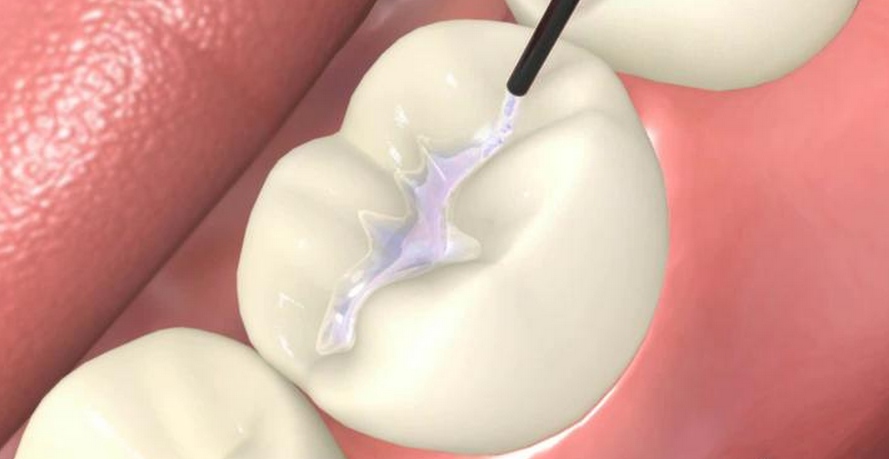 Trám răng có đau không và hướng khắc phục hiệu quả